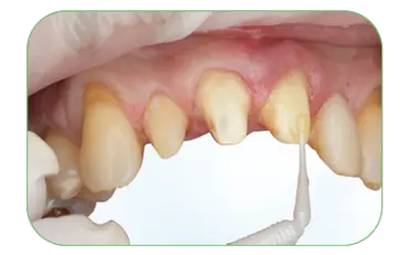 Application of adhesive bonding agent to tooth surface. Gently air dry.