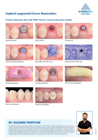 Implant-supported Crown Restoration