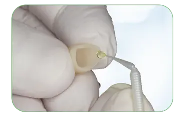 Application of VISALYS® RESTORATIVE PRIMER onto the inner surface of crown.