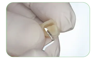 The composite material is evenly applied to the crown – ready for placement.