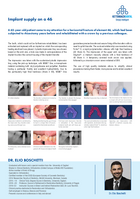 Implant supply on a tooth 46