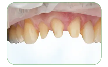 Prepared teeth after removal of old ceramic restorations.