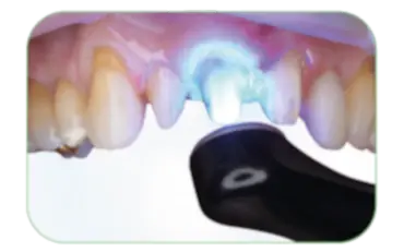 Light-cure for 20 seconds (if required for the primer).