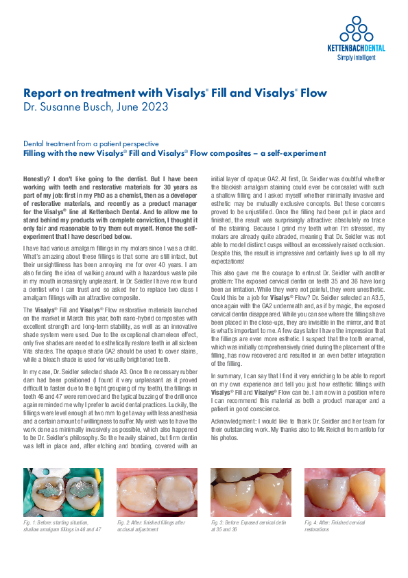 Report on treatment with Visalys® Fill and Visalys® Flow