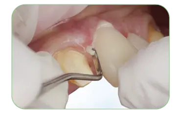 Placing crown and removal of excess material at the marginal area.