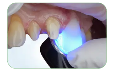 Final light-cure for 20 seconds at each side followed by finishing marginal edges with diamond bur and polishers.