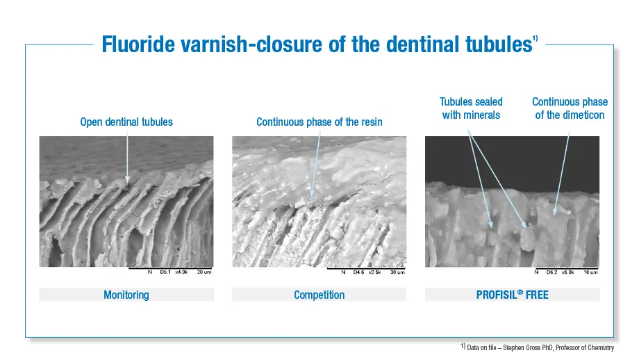 Fluoride varnish-closure of the dentail tubules
