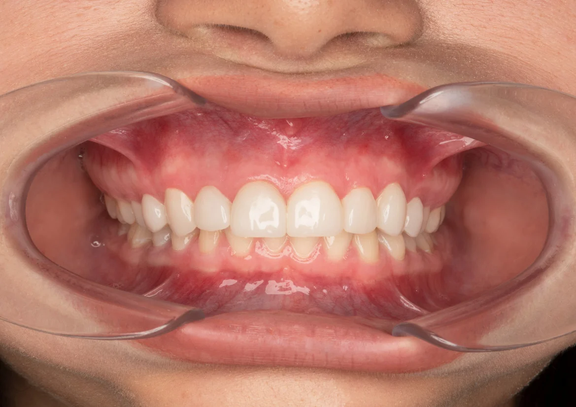 Tooth model with BioCeramic