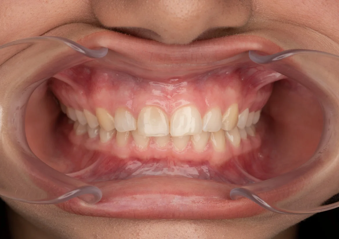 Tooth model without BioCeramic